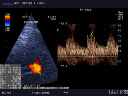 Ultrazvok možganskih žil - anevrizma sprednje komunikantne arterije